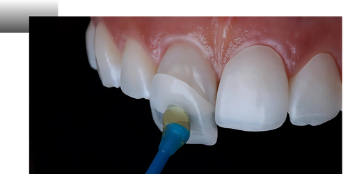 Clinica Dra. Kariny Werle - Lentes de Contato Dental em São Paulo