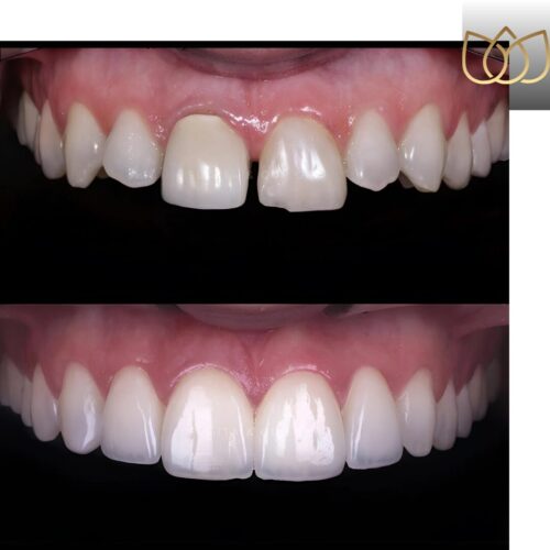 Clinica Dra. Kariny Werle - Lentes de Contato Dental em São Paulo